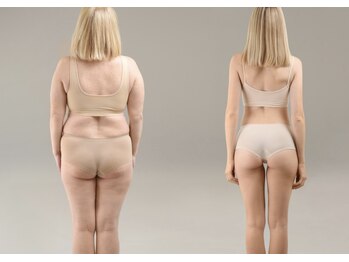 サロン ド モア(salon de MORE)の写真/頑張っても落ちにくい！二の腕・背中のハミ肉を集中ケア！！