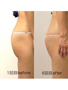 ミヨン(Miyong)/ぷりっとヒップアップ!