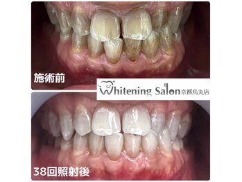 ホワイトニングサロン 京都烏丸店/ホワイトニング施術例