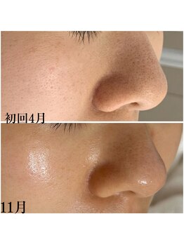 プラセル(Placer)/毛穴はもちろん!本格肌質改善も