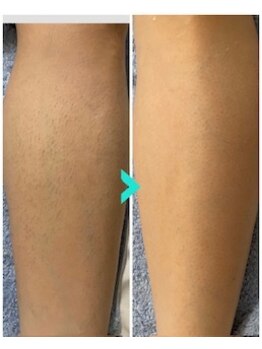 ミルキー(Milky)/マツヤニで足も脱毛できます