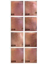 イロドリ(irodori)/本格肌改善ガリレオピーリング☆