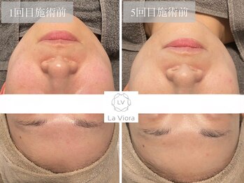 ラヴィオーラ 川崎(La Viora)/ダイヤモンドハーブピーリング