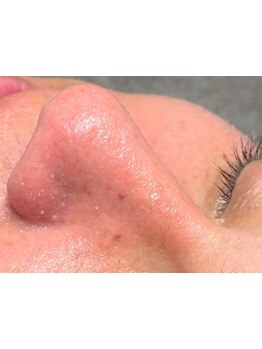 毛穴ケアをしたい