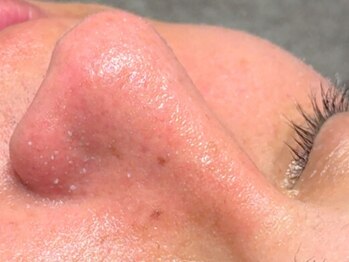 ザ ベルネス(The bellness)の写真/《黒ずみ・ザラつき・角栓を徹底ケア》1回で実感できる“つるん肌”◎メイクが乗らない/毛穴の開き/くすみ