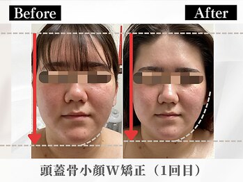 ポーベルポー(Peau Belle poe)/人気No.1/頭蓋骨小顔W矯正1回目