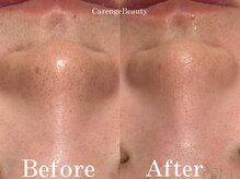 カレンジェビューティー(CarengeBeauty)/ハイドラ水光ピーリング