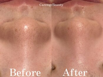 カレンジェビューティー(CarengeBeauty)/ハイドラ水光ピーリング