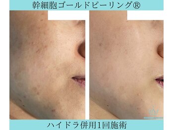 リメイククリニカルビューティー(Remake clinical beauty)/幹細胞ゴールドピーリングは