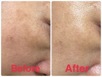 セラピア(Serapia)/水光肌ピーリング