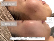 ラヴィオーラ 川崎(La Viora)/ダイヤモンドハーブピーリング