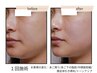 【人気No.2】二重あご脂肪分解×小顔フェイシャル ￥15,000→￥9,900