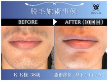 メンズビービー 福井高柳店(MEN'S BB)/ヒゲ脱毛施術事例