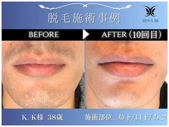 メンズビービー 福井高柳店(MEN'S BB)/ヒゲ脱毛施術事例