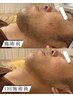【男女OK☆脱毛後の乾燥防止】鼻毛穴洗浄＋顔脱毛+幹細胞導入¥14500→¥9600