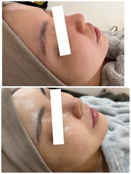 リノ レイ(Lino Ray)/PHA水光ピーリング