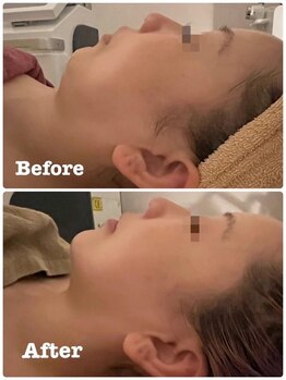 ハッテンビューティーパーク 神戸店(Hatten Beauty Park 810)/整形級小顔ビフォーアフター