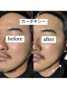 フリーク バイ シュリット 渋谷(fleek! by schritt)/【強炭酸カーボキシーパック】