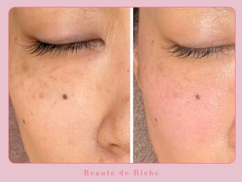 ボーテドリッシュ(Beaute de Riche)/シミケアにオススメのリアボーテ