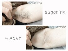 エイシー(ACEY)/ビフォーアフター☆脇