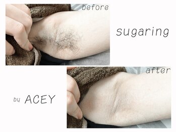 エイシー(ACEY)/ビフォーアフター☆脇