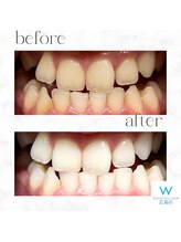 ホワイトニングショップ 広島店(WHITENING SHOP)/【ホワイトニング】Before After