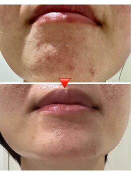 エミナル(eminal)/ビフォー/アフター/毛穴/梅田