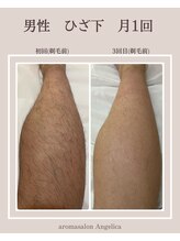 アンジェリカ(Angelica)/メンズひざ下脱毛