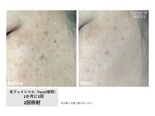 プライム(Prime)/光フェイシャル