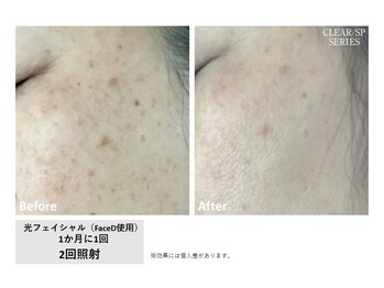 プライム(Prime)/光フェイシャル