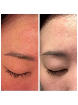 デイジー/痒み・赤ら顔にグリーンピール