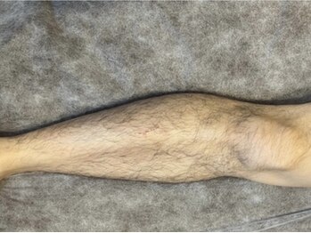 ヨハク(YOHAKU)/20代後半　男性　9回施術before