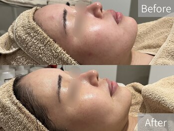 シェリーミル(Cherie Miru)/赤み/シミ/くすみ/毛穴