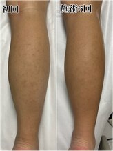 ルシャトン(Le Chaton)/脚脱毛