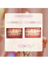 プラスビー 3号店(+b)/ホワイトニングビフォーアフター
