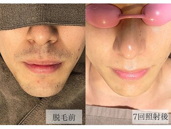 メンズアルファ/【髭】光脱毛before after 30代