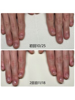 エヌスタイル(N-STYLE)/深爪改善ケア