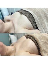 セレーネ(Selene)/お客様before.after