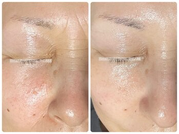 エスケア(S-CARE)/シミケアにも光フェイシャル☆