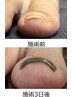 器具なし巻き爪やさしくジェルケア◎フットワンカラー込み♪