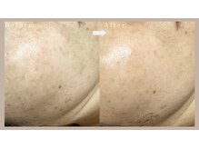 ネリネ(Nerine)/トラネキサム酸美容液の効果