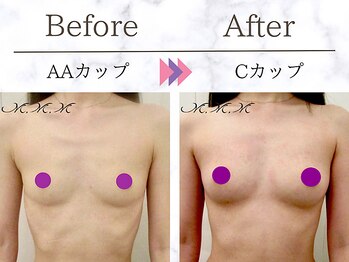 メディカルサロン エム エム エム 銀座プレミアムサロン(M.M.M.)/【バストアップ例】AA→Cカップ