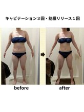 クリア(Clear)/キャビテーション・筋膜リリース