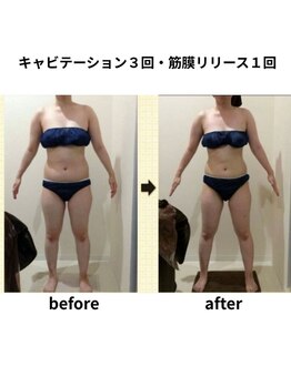 クリア(Clear)/キャビテーション・筋膜リリース