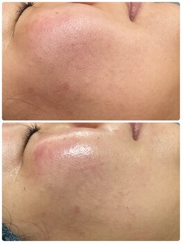 アスピリア(aspirer a')/白玉スノーピーリング☆