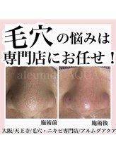 アルムダアクア 天王寺店(Aleumda AQUA)/毛穴エクストラクションプロ大阪
