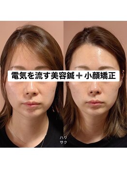 ハリサク/施術前後