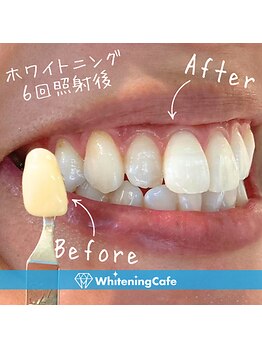 ホワイトニングカフェ 池袋東口店/ホワイトニングビフォーアフター