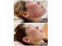 ニキビケア研究所 吉祥寺店