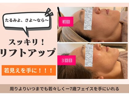 フォーエリミスプラス(for elims+)の写真